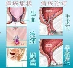 痔疮的症状图片女性,识别与预防之道